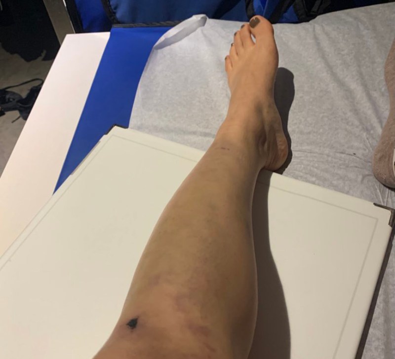 Julie Won's leg. Photo: Julie Won